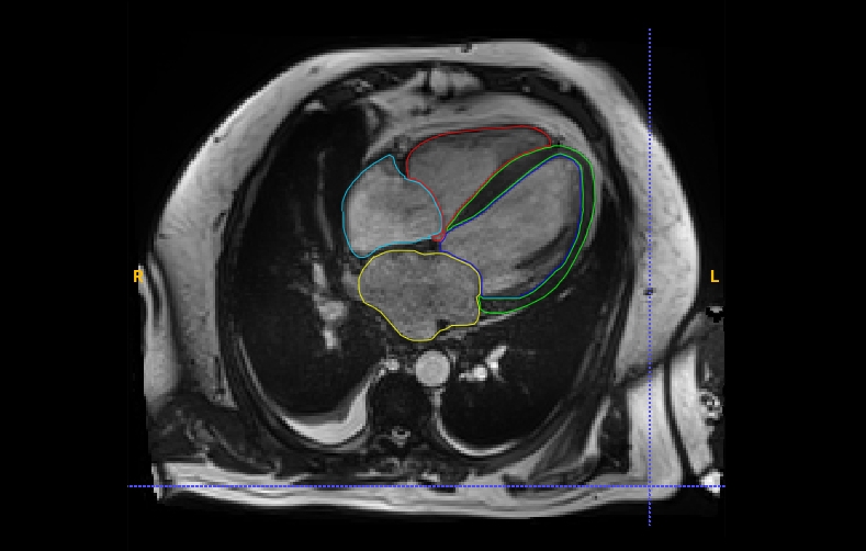 3D segmentation