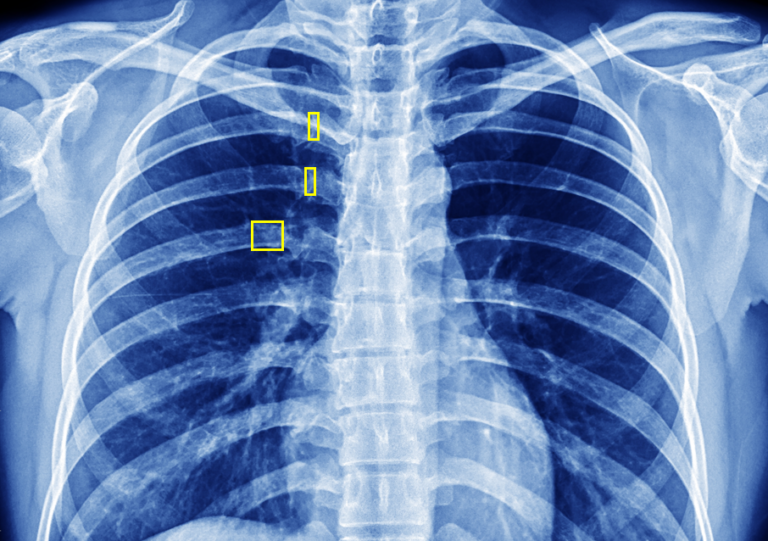 Rib Fractures on Frontal Chest X-rays