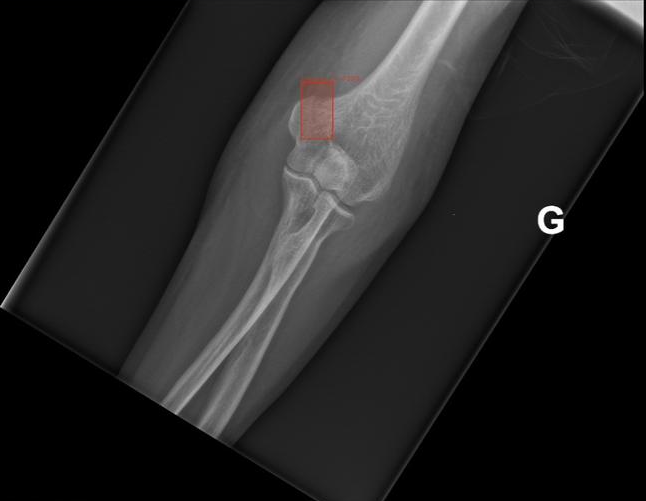 bone_seg(msk)