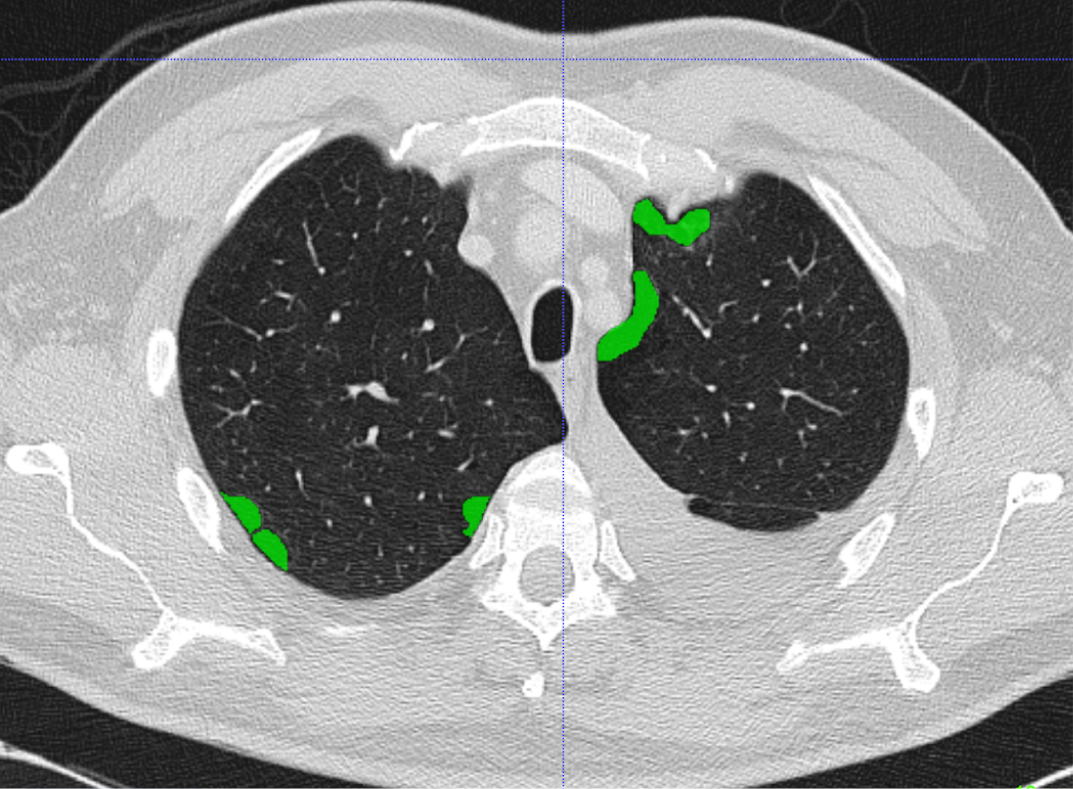 lung_seg